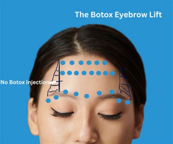 How many units Botox for hooded eyes?