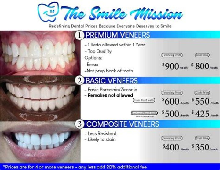 How much do veneers cost?