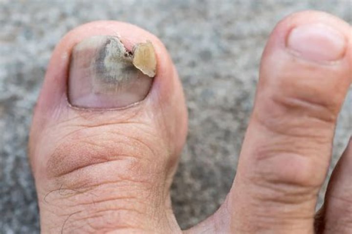 How often do you put Vicks on toenails?