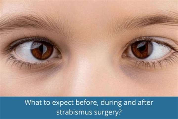 How often does strabismus surgery fail?