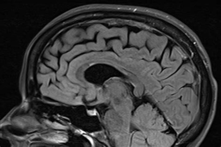 How often is MS missed on MRI?