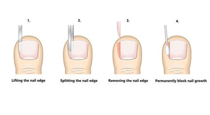 How painful is a toenail biopsy?
