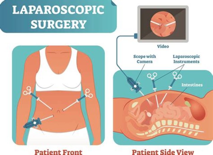 How painful is laparoscopic surgery?