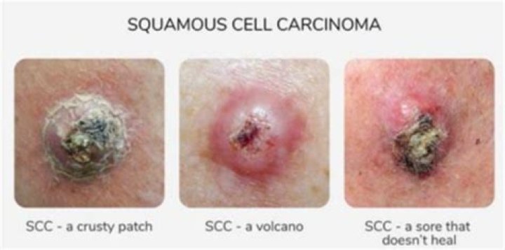 How quickly does skin cancer spread?