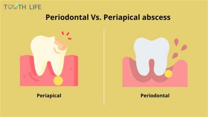 How serious is a periodontal abscess?