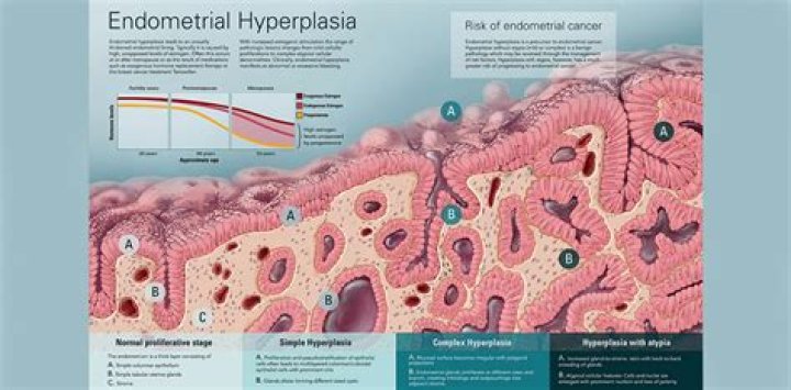 How serious is endometrial hyperplasia?