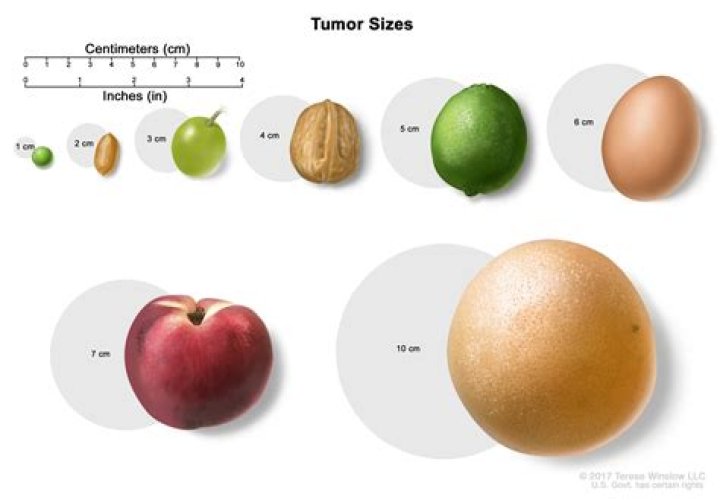 Is a 5 cm tumor considered large?
