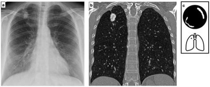 Is a 7mm lung nodule big?