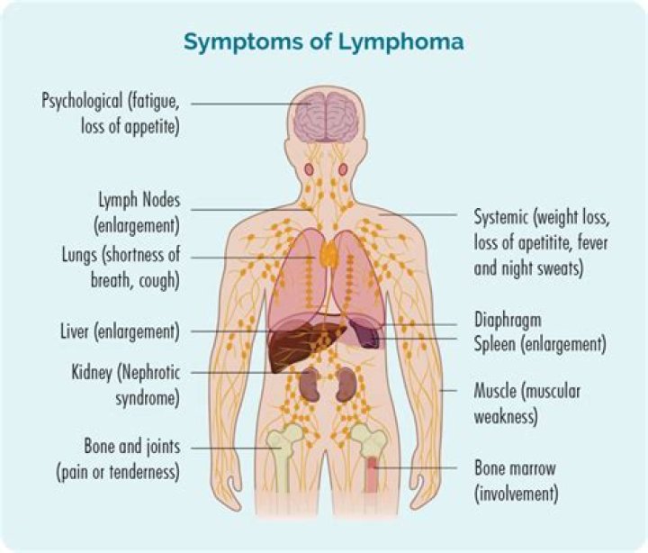 Is a dry cough a symptom of lymphoma?