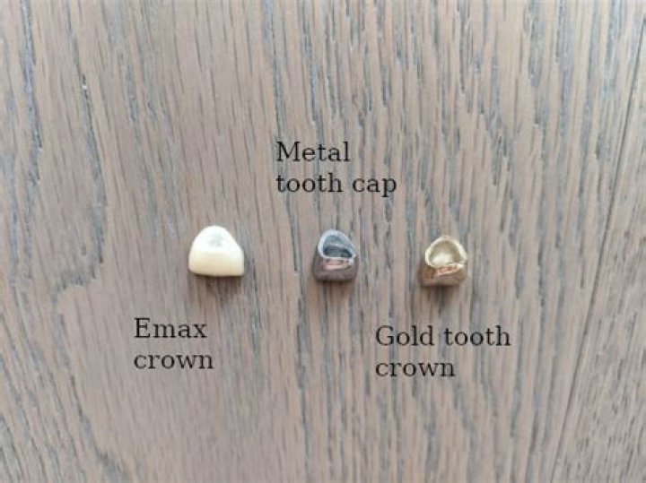 Is a gold tooth cheaper than a crown?