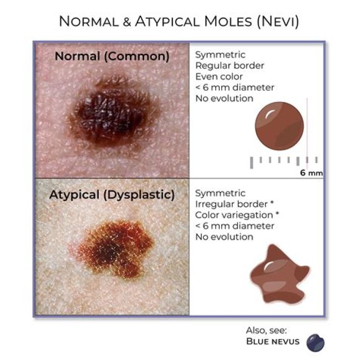 Is a GREY mole normal?