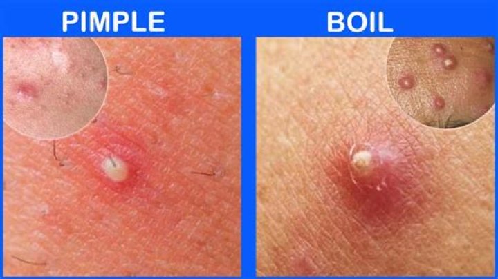 Is a pimple a boil?