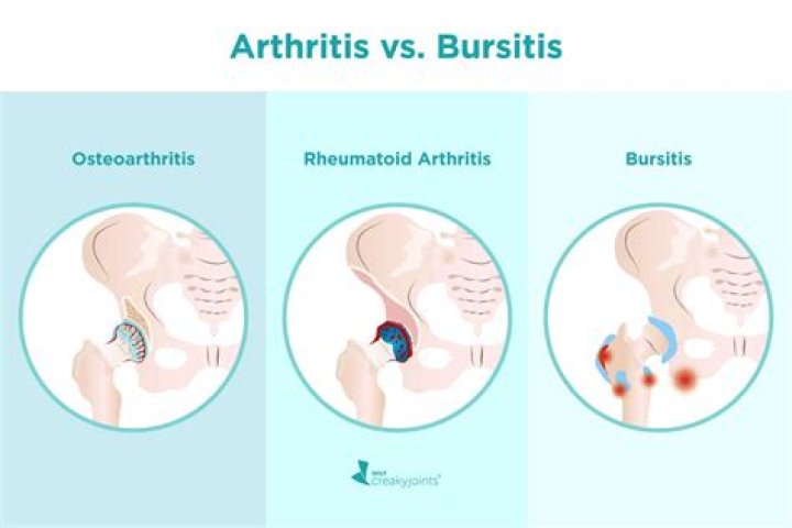 Is bursitis a form of arthritis?