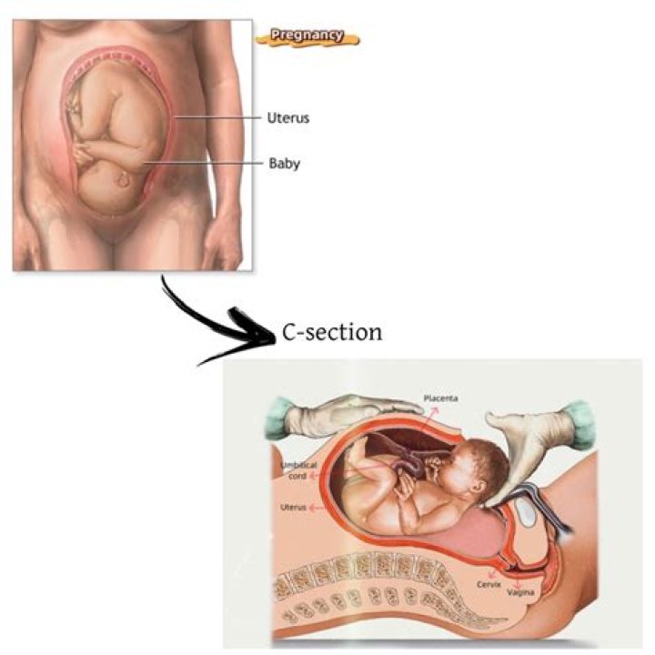 Is C-section more risky than vaginal birth?