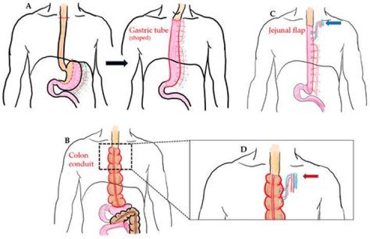 Is esophageal stricture life threatening?