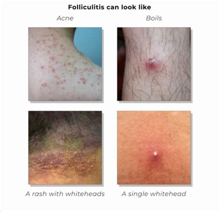 Is folliculitis a fungal infection?