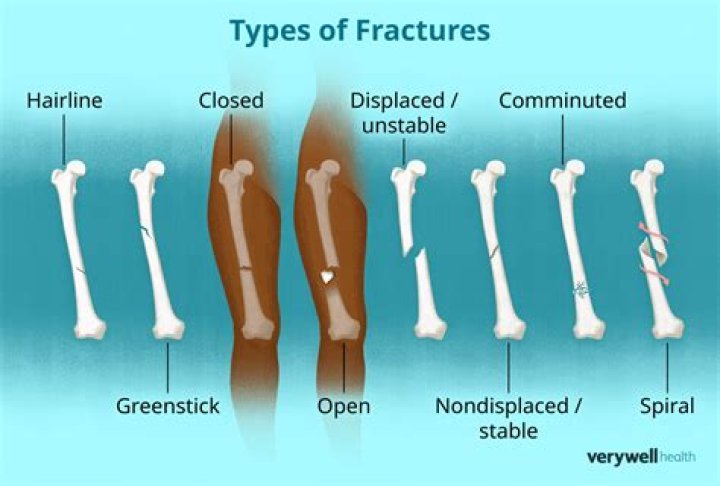 Is fracture a grievous injury?