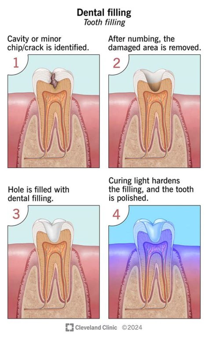 Is GIC a permanent filling?