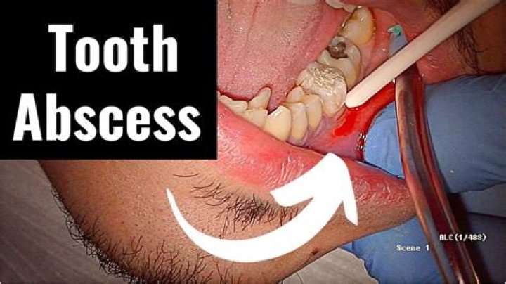 Is heat good for an abscessed tooth?