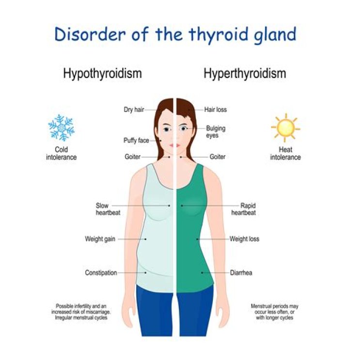 Is hypothyroidism considered an autoimmune disease?