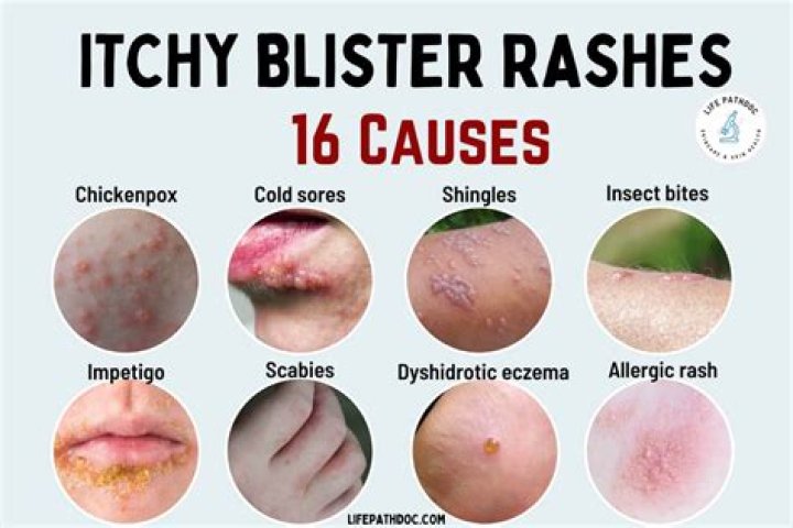 Is it a rash or shingles?