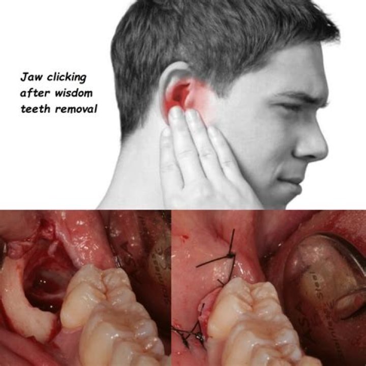Is it better to fill or pull a wisdom tooth?