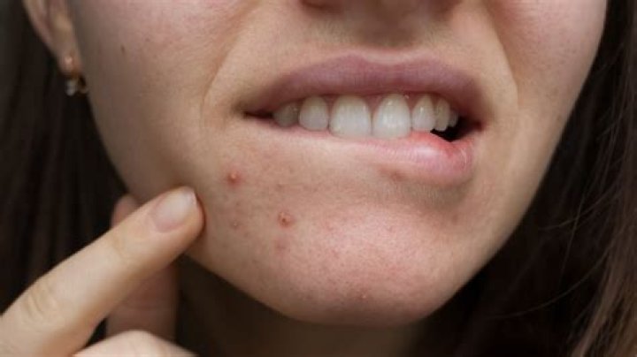 Is it normal for pimples to smell?