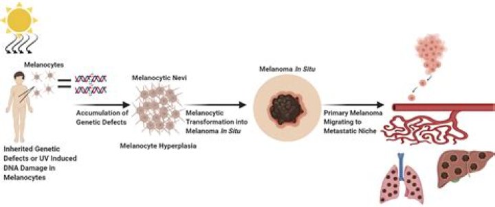 Is melanoma genetic?