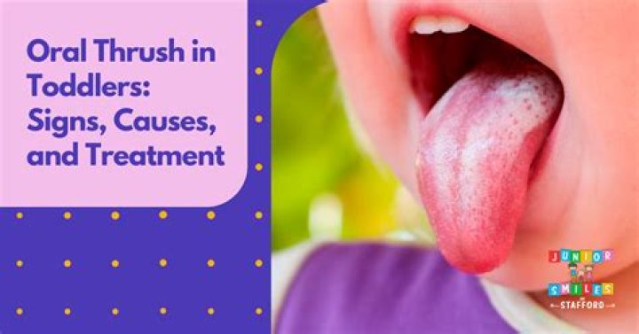 Is oral thrush an STD?