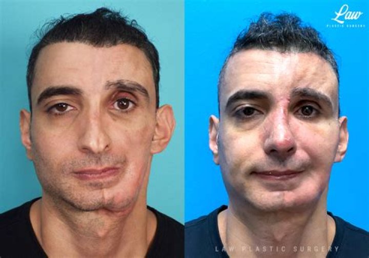 Is otoplasty covered by health insurance?