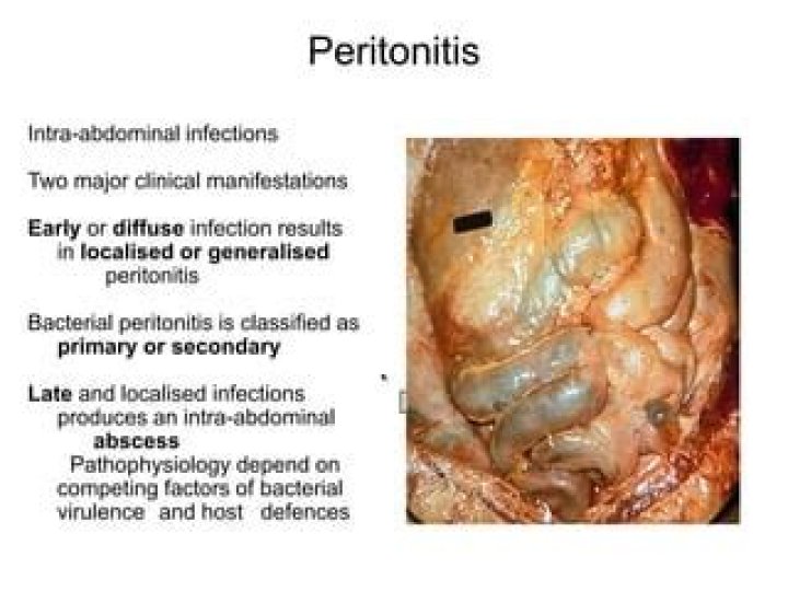 Is peritonitis contagious?