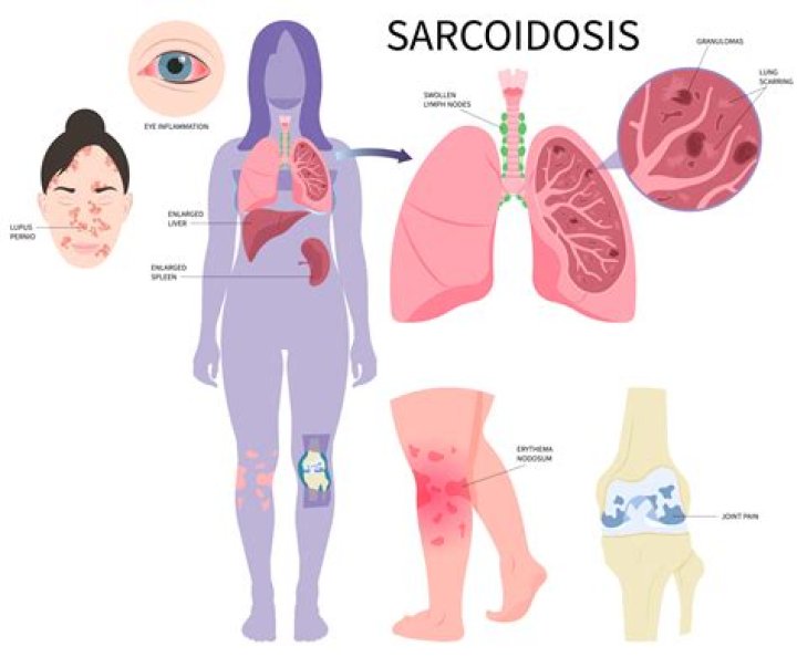 Is sarcoidosis considered COPD?