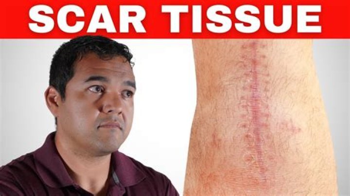Is scar tissue a hard lump?
