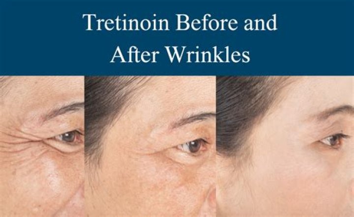 Is strivectin good for wrinkles?