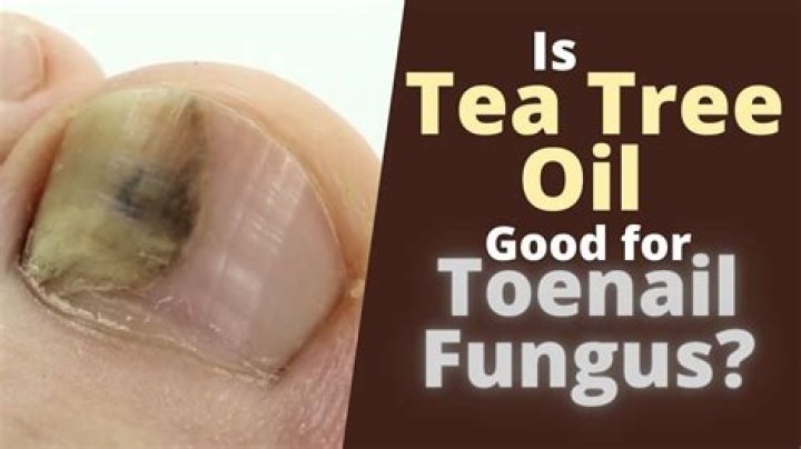 Is Tea Tree Oil Good for toenail fungus?