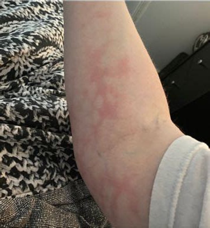 Is there a Covid rash?