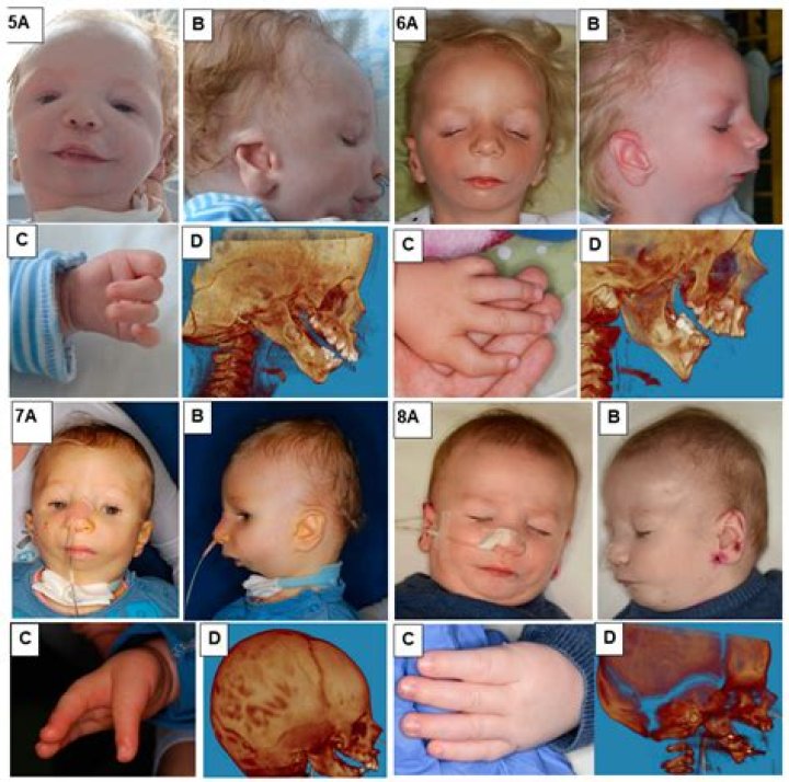 Is there a cure for Nager syndrome?