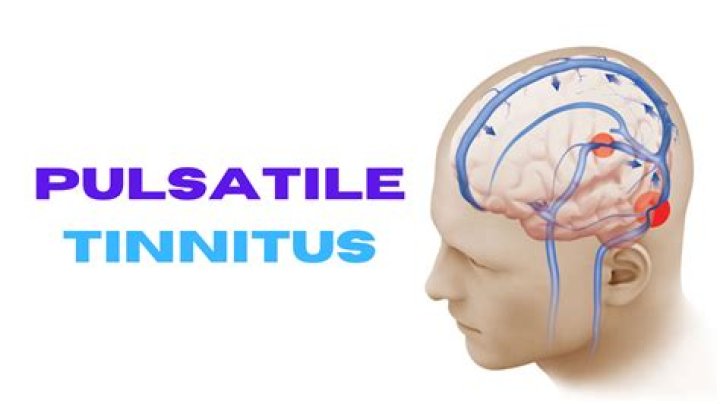 Is there a cure for pulsatile tinnitus?