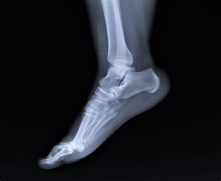 Should I get an xray for a sprained ankle?