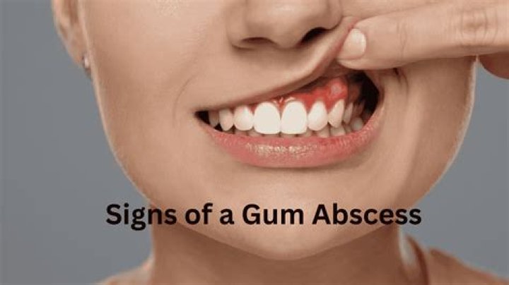 Should I squeeze pus out of gum abscess?