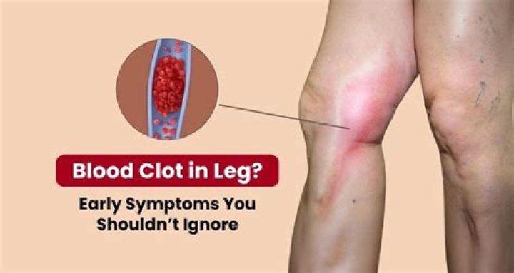 Should you elevate leg blood clot?