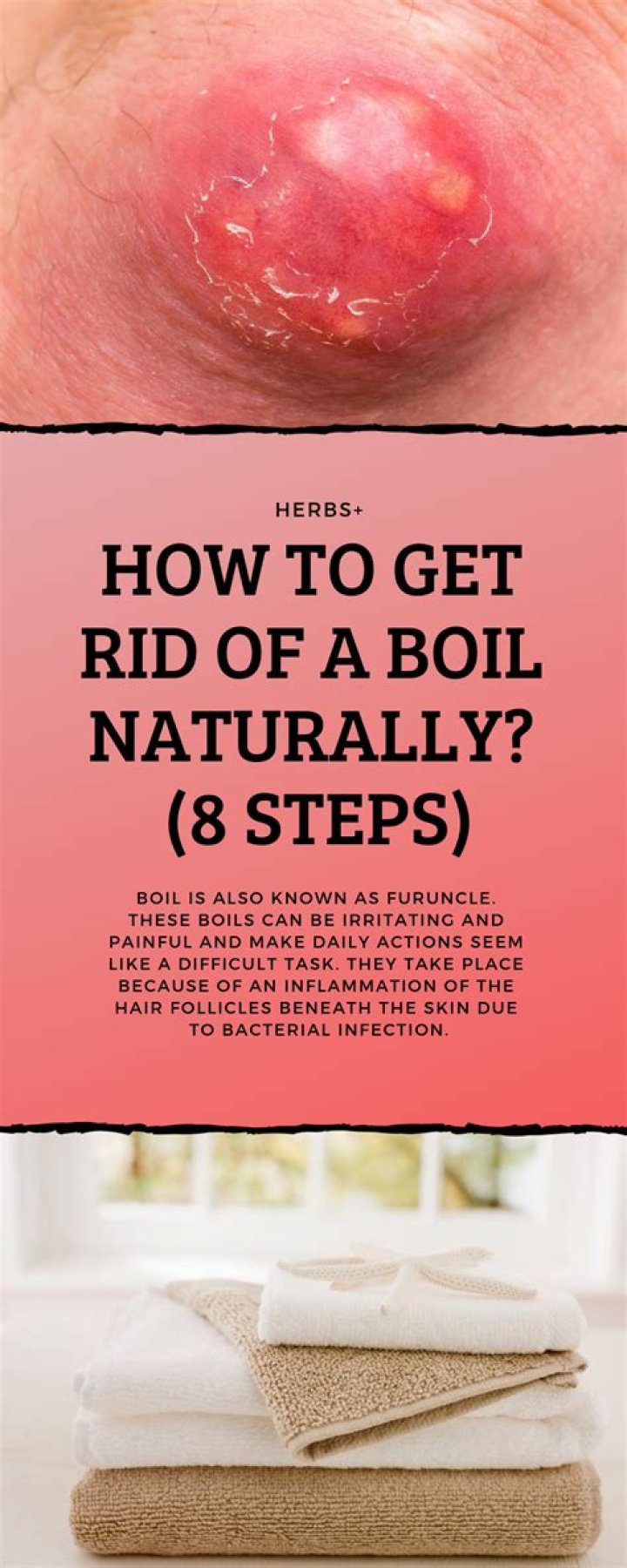 Should you squeeze a boil?