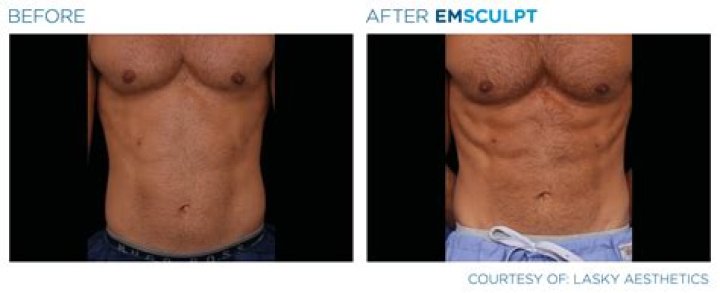 What age is Emsculpt for?