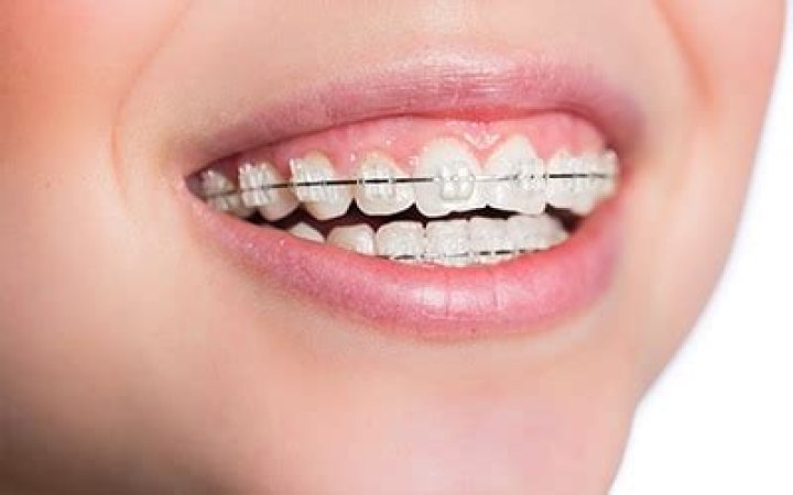 What age is too late for braces?