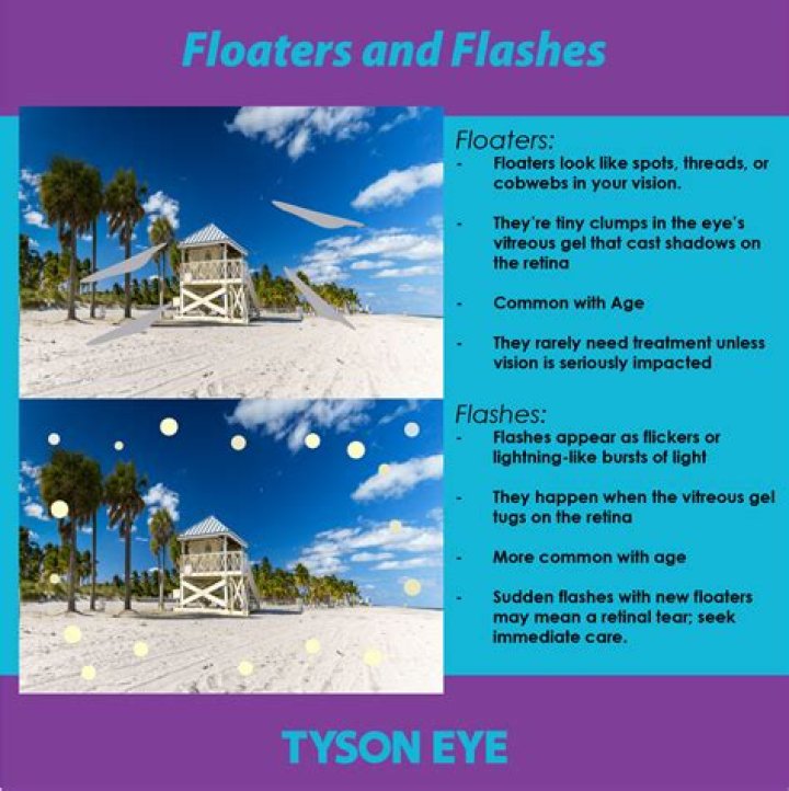 What are floaters and flashes in the eye?