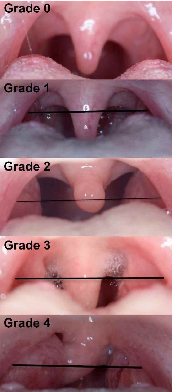 What are Grade 4 tonsils?