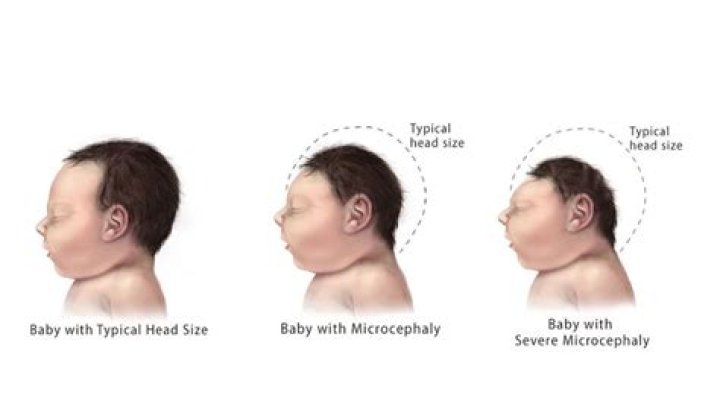 What are the chances of Zika causing microcephaly?