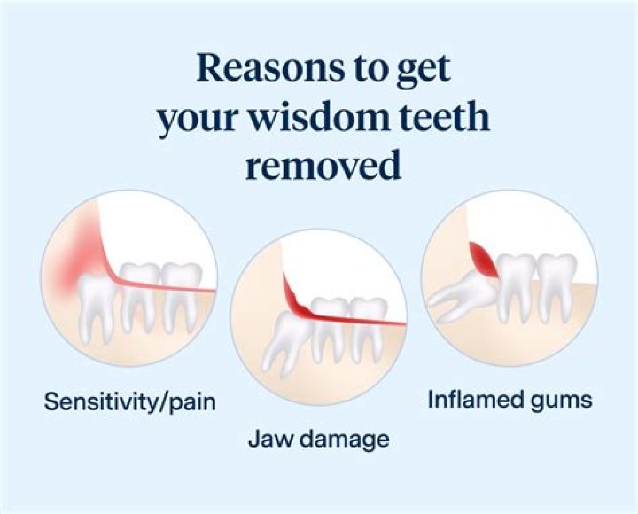 What are the disadvantages of removing wisdom teeth?