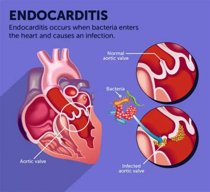 What are the warning signs of endocarditis?