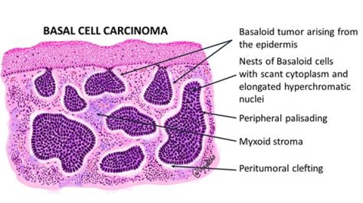 What body systems are affected by basal cell carcinoma?